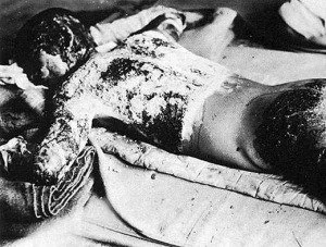 Torso of a boy exposed to the atomic bomb