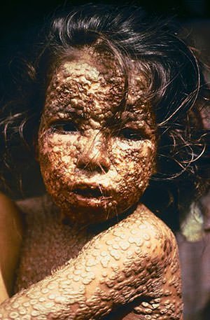A child with smallpox
